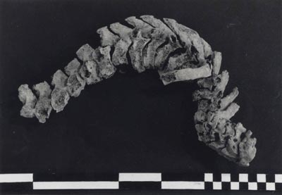 An example of archaeologicalogically recovered spine showing fusing of vertebrae from tuberculosis
